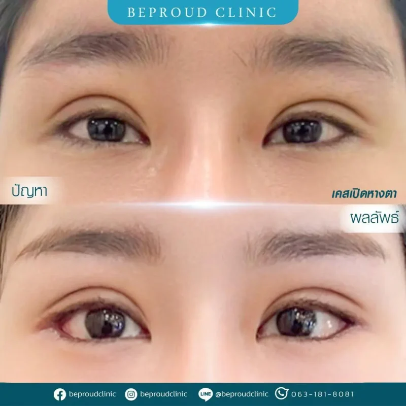 ภาพรีวิวเปรียบเทียบผลลัพธ์ ก่อนทำ-หลังทำศัลยกรรม ของเคสตัวอย่าง เปิดหางตา กดตาล่าง โดยอ.หมอหลิง บีพราวด์คลินิก