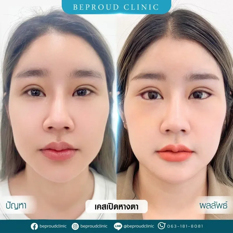 ภาพรีวิวเปรียบเทียบผลลัพธ์ ก่อนทำ-หลังทำศัลยกรรม ของเคสตัวอย่าง เปิดหางตา กดตาล่าง โดยอ.หมอหลิง บีพราวด์คลินิก