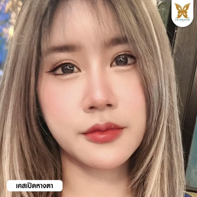 ภาพรีวิวเปรียบเทียบผลลัพธ์ ก่อนทำ-หลังทำศัลยกรรม ของเคสตัวอย่าง เปิดหางตา กดตาล่าง โดยอ.หมอหลิง บีพราวด์คลินิก