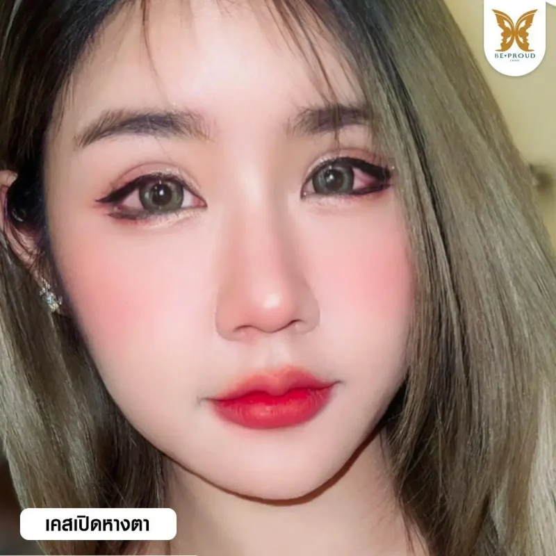 ภาพรีวิวเปรียบเทียบผลลัพธ์ ก่อนทำ-หลังทำศัลยกรรม ของเคสตัวอย่าง เปิดหางตา กดตาล่าง โดยอ.หมอหลิง บีพราวด์คลินิก