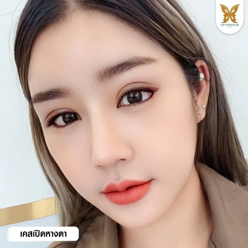 ภาพรีวิวเปรียบเทียบผลลัพธ์ ก่อนทำ-หลังทำศัลยกรรม ของเคสตัวอย่าง เปิดหางตา กดตาล่าง โดยอ.หมอหลิง บีพราวด์คลินิก