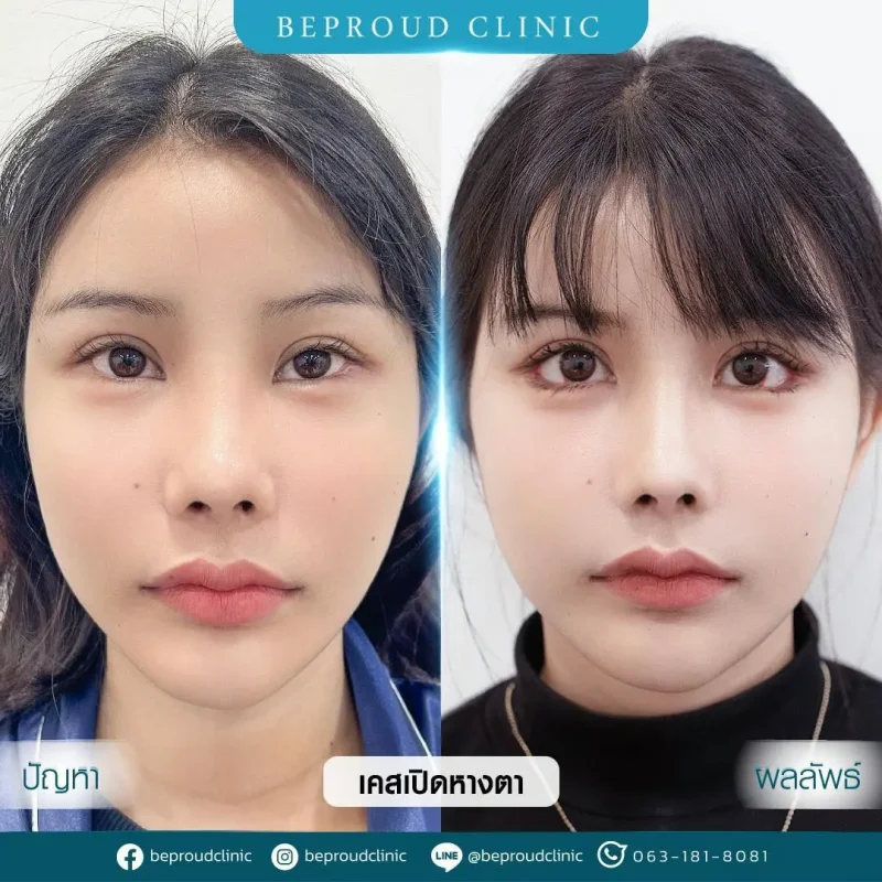 ภาพรีวิวเปรียบเทียบผลลัพธ์ ก่อนทำ-หลังทำศัลยกรรม ของเคสตัวอย่าง เปิดหางตา กดตาล่าง โดยอ.หมอหลิง บีพราวด์คลินิก