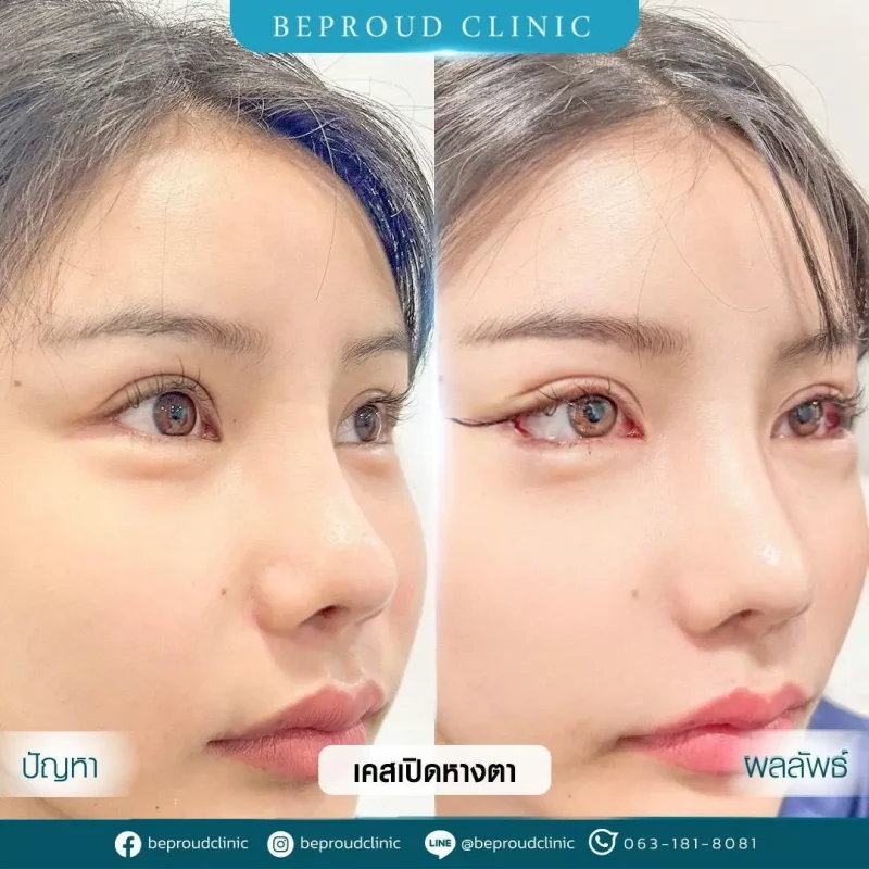 ภาพรีวิวเปรียบเทียบผลลัพธ์ ก่อนทำ-หลังทำศัลยกรรม ของเคสตัวอย่าง เปิดหางตา กดตาล่าง โดยอ.หมอหลิง บีพราวด์คลินิก