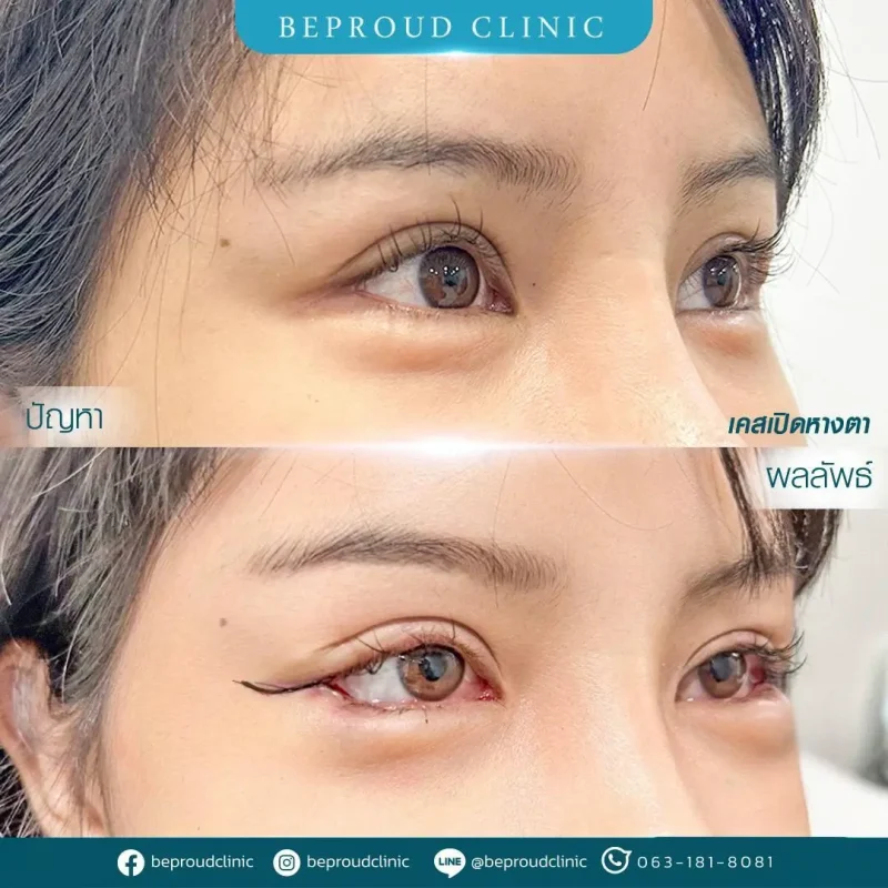 ภาพรีวิวเปรียบเทียบผลลัพธ์ ก่อนทำ-หลังทำศัลยกรรม ของเคสตัวอย่าง เปิดหางตา กดตาล่าง โดยอ.หมอหลิง บีพราวด์คลินิก