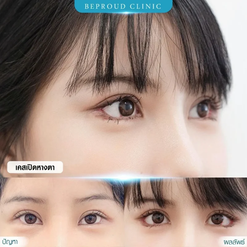 ภาพรีวิวเปรียบเทียบผลลัพธ์ ก่อนทำ-หลังทำศัลยกรรม ของเคสตัวอย่าง เปิดหางตา กดตาล่าง โดยอ.หมอหลิง บีพราวด์คลินิก