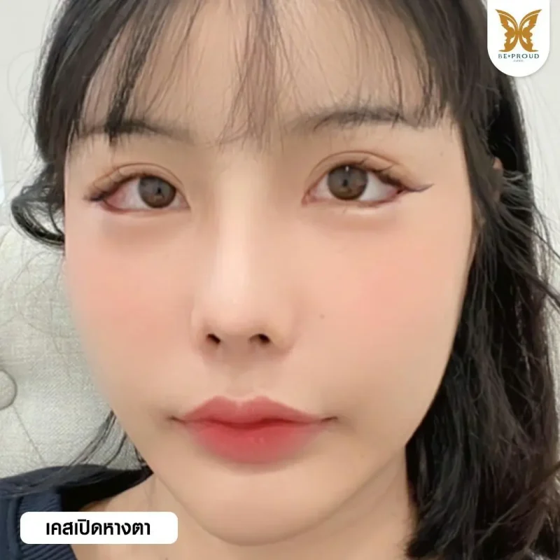 ภาพรีวิวเปรียบเทียบผลลัพธ์ ก่อนทำ-หลังทำศัลยกรรม ของเคสตัวอย่าง เปิดหางตา กดตาล่าง โดยอ.หมอหลิง บีพราวด์คลินิก