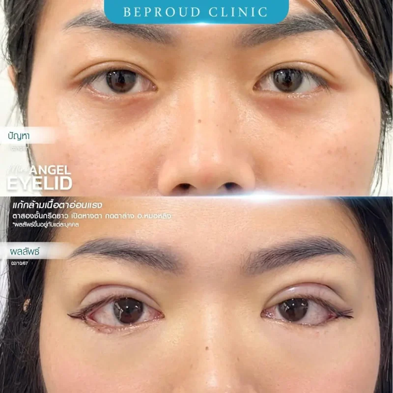 ภาพรีวิวเปรียบเทียบผลลัพธ์ ก่อนทำ-หลังทำศัลยกรรมตาสองชั้น ของเคสตัวอย่าง เทคนิคกรีดตายาว เปิดหางตา กดตาล่าง แก้กล้ามเนื้อตาอ่อนแรง โดยอ.หมอหลิง บีพราวด์คลินิก