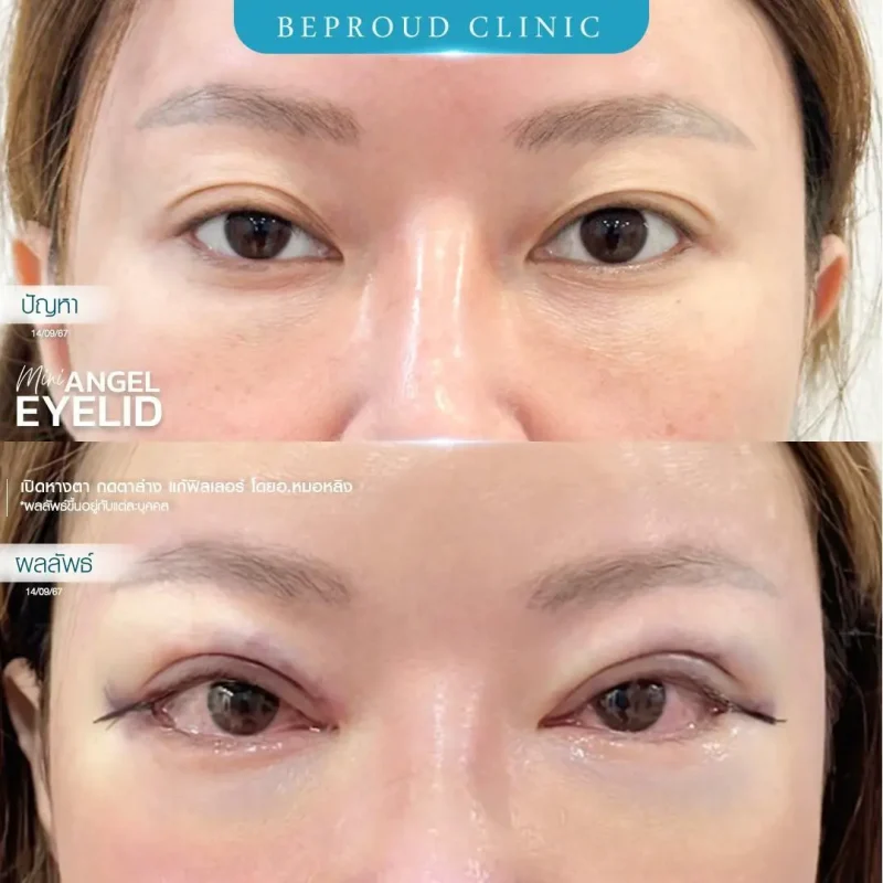 ภาพรีวิวเปรียบเทียบผลลัพธ์ ก่อนทำ-หลังทำศัลยกรรม ของเคสตัวอย่าง เปิดหางตาและกดตาล่าง แก้ฟิลเลอร์ โดยอ.หมอหลิง บีพราวด์คลินิก
