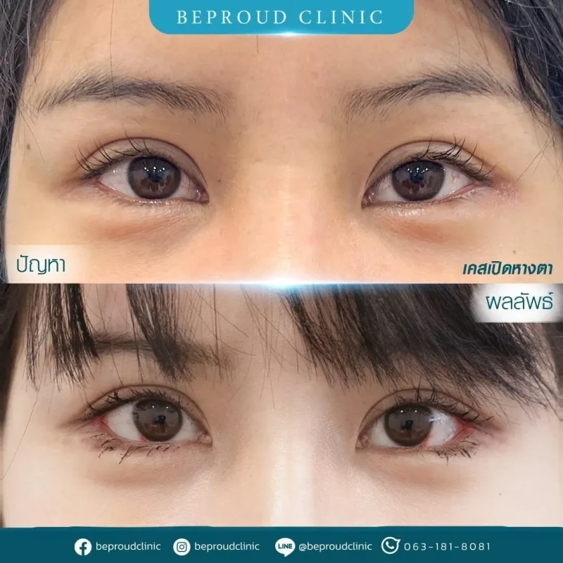 ภาพรีวิวเปรียบเทียบผลลัพธ์ ก่อนทำ-หลังทำศัลยกรรม ของเคสตัวอย่าง เปิดหางตา กดตาล่าง โดยอ.หมอหลิง บีพราวด์คลินิก