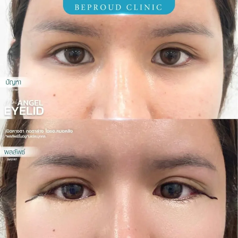 ภาพรีวิวเปรียบเทียบผลลัพธ์ ก่อนทำ-หลังทำศัลยกรรม ของเคสตัวอย่าง เปิดหางตาและกดตาล่าง โดยอ.หมอหลิง บีพราวด์คลินิก
