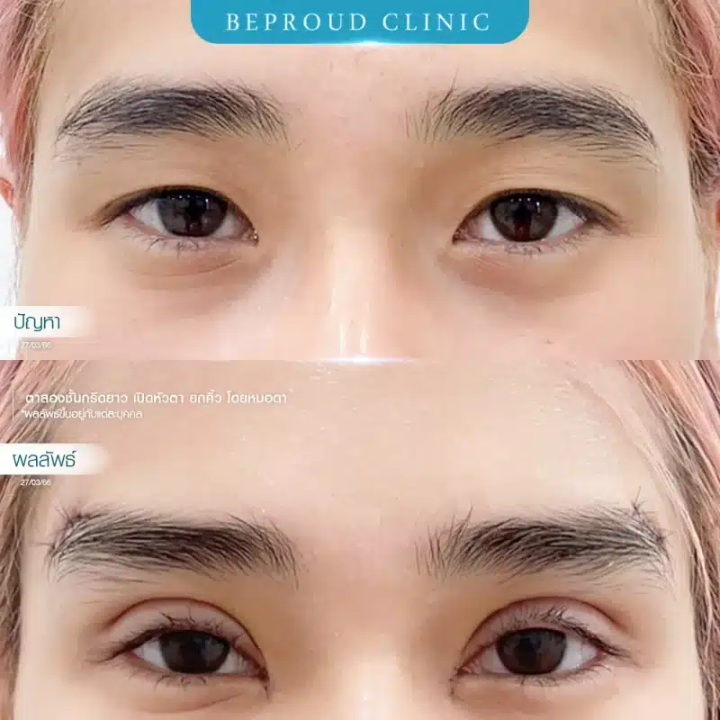ภาพรีวิว ยกคิ้วร่วมกับเปิดหัวตา เคสตาตลบน้อย โดยหมอดา Beproud Clinic แสดงผลลัพธ์ดวงตาที่เปิดกว้างและหางคิ้วยกสูงขึ้น