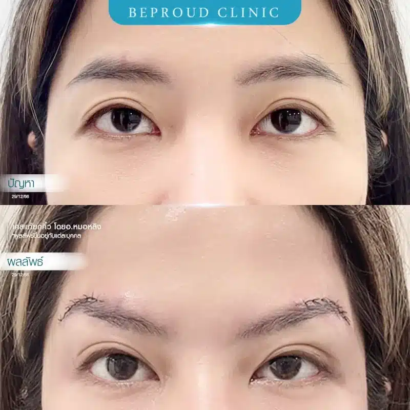ภาพเปรียบเทียบก่อน-หลัง ยกคิ้ว (เคสแก้คิ้วตก) โดยหมอหลิง Beproud Clinic แสดงผลลัพธ์ดวงตาที่เปิดกว้างและคิ้วยกสูงขึ้น
