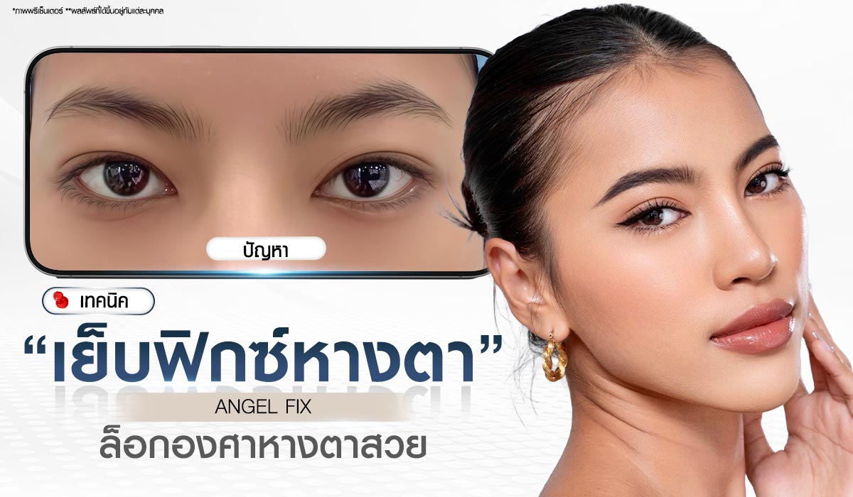 เทคนิคศัลยกรรมตา เย็บยกหางตา Angel Fix บีพราวด์คลินิก