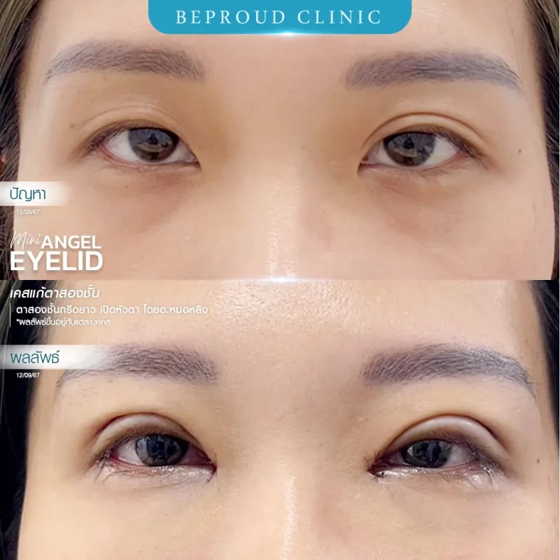 ภาพรีวิวเปรียบเทียบผลลัพธ์ ก่อนทำ-หลังทำศัลยกรรมแก้ตาสองชั้น ของเคสตัวอย่าง เทคนิคกรีดตายาว และเปิดหัวตา โดยอ.หมอหลิง บีพราวด์คลินิก