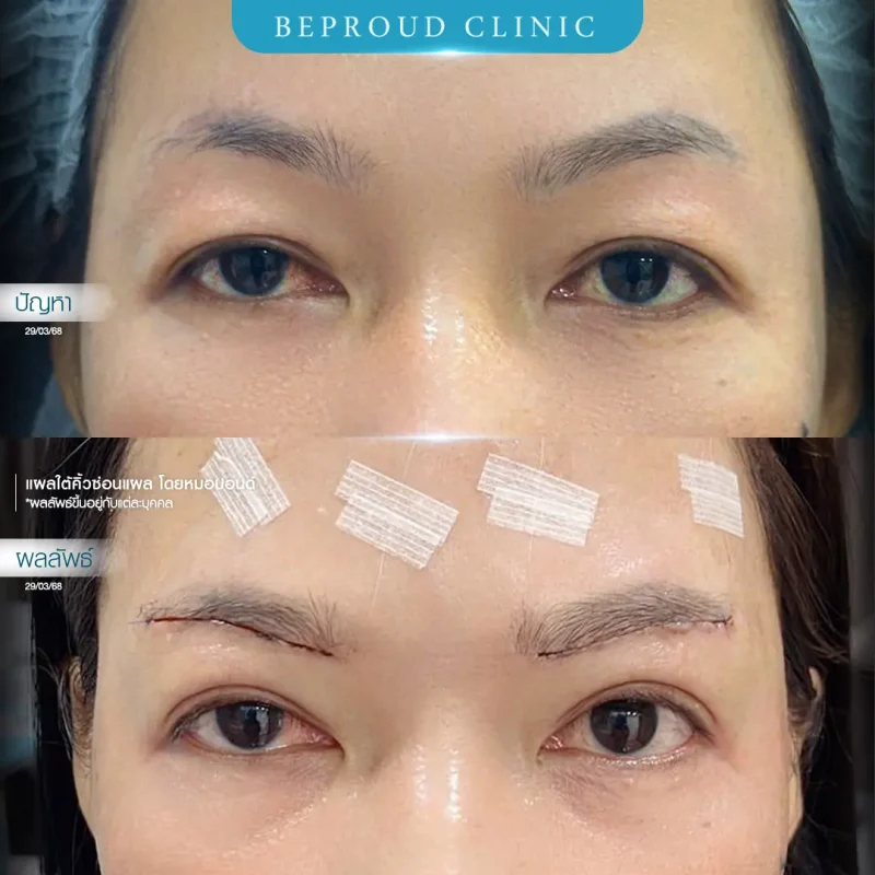 ภาพรีวิวเปรียบเทียบผลลัพธ์ ก่อนทำ-หลังทำศัลยกรรมแผลใต้คิ้วซ่อนแผล โดยหมอปอนด์ บีพราวด์คลินิก