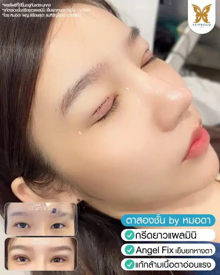 ภาพรีวิวก่อนและหลังทำศัลยกรรมตา โดยหมอดา ซึ่งทำตาสองชั้นเทคนิคกรีดยาวแผลมินิร่วมกับ Angel Fix เย็บยกหางตาและแก้กล้ามเนื้อตาอ่อนแรง แสดงผลลัพธ์ที่ได้ชั้นตาคมชัดและแก้หางตาตกให้ยกขึ้น