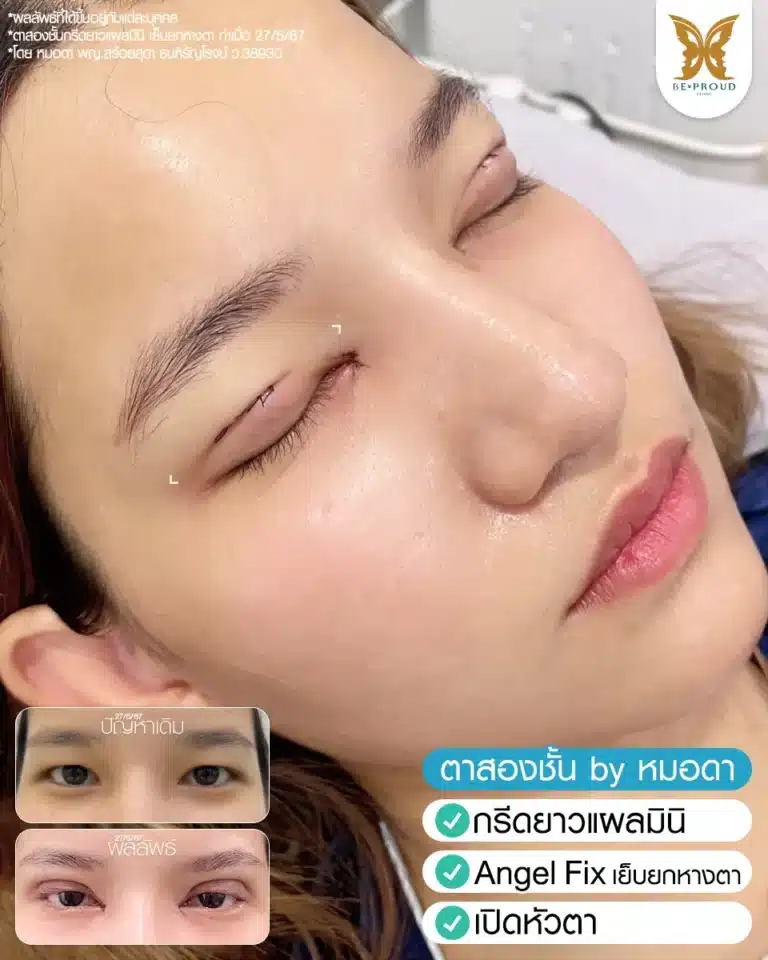 ภาพรีวิวก่อนและหลังทำศัลยกรรมตา โดยหมอดา ซึ่งทำตาสองชั้นเทคนิคกรีดยาวแผลมินิร่วมกับ Angel Fix เย็บยกหางตาและเปิดหัวตา แสดงผลลัพธ์ที่ได้ชั้นตาคมชัดและแก้หางตาตกให้ยกขึ้น