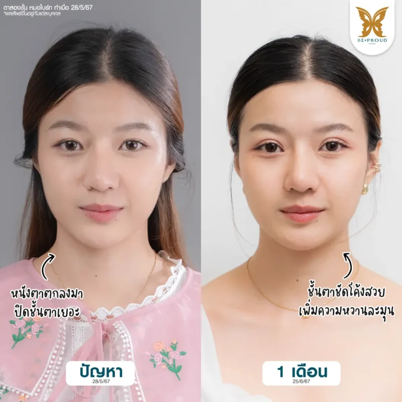 ภาพหน้าตรงแสดงปัญหาชั้นตาก่อนทำศัลยกรรมของคุณหยก ละครคุณธรรม ลักษณะตาหมวย ชั้นตาไม่ชัด และชั้นตาหลบใน ดูเหมือนตาชั้นเดียว