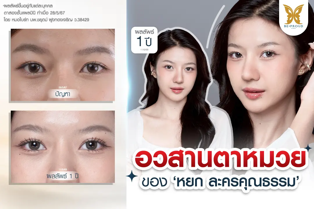 เปรียบเทียบภาพก่อนและหลังทำตาสองชั้นครบ 1 ปี ของคุณหยก ละครคุณธรรม ด้วยเทคนิคกรีดยาวแผลมินิ ที่ บีพราวด์ คลินิก เปลี่ยนตาหมวยชั้นตาหลบใน ให้กลายเป็นตาสองชั้นสวยหวาน เป็นธรรมชาติ โดยหมอไบร์ท