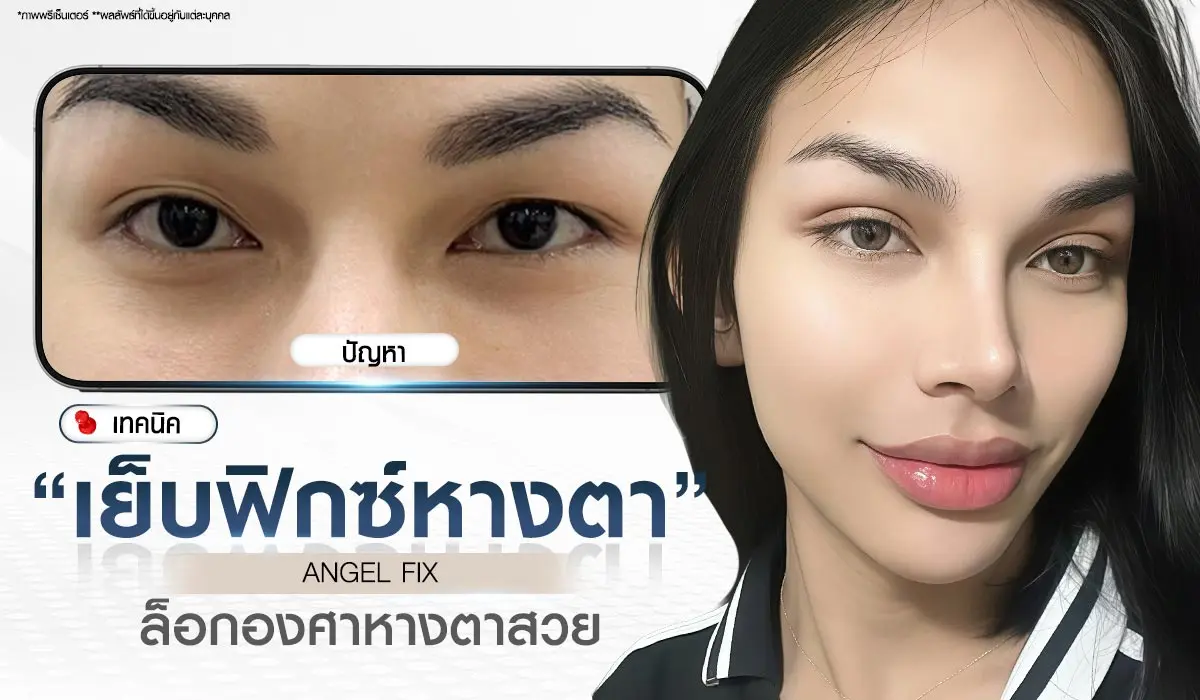 เทคนิคศัลยกรรมตา เย็บยกหางตา Angel Fix บีพราวด์คลินิก