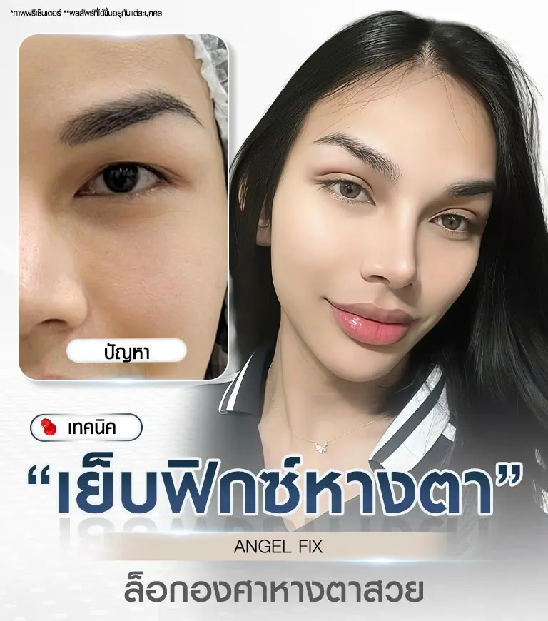 เทคนิคศัลยกรรมตา เย็บยกหางตา Angel Fix บีพราวด์คลินิก