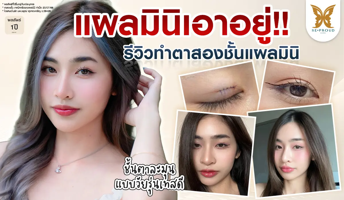 ภาพรีวิวผลลัพธ์หลังทำตาสองชั้นครบ 1 ปี ของคุณยูเน็ต ด้วยเทคนิคกรีดยาวแผลมินิ โดย หมอไบร์ท บีพราวด์ คลินิก