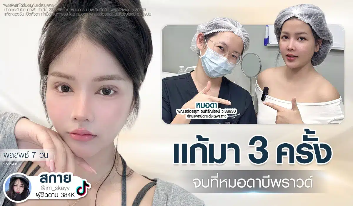 ศัลยกรรมตาไม่จบที่ครั้งแรก รีวิวแก้ตาสองชั้นคุณสกาย แก้มา 3 ครั้ง มาจบที่แพทย์เฉพาะทาง หมอดา บีพราวด์คลินิก ผลลัพธ์หลังทำ 7 วัน ตาดูสวยหวาน