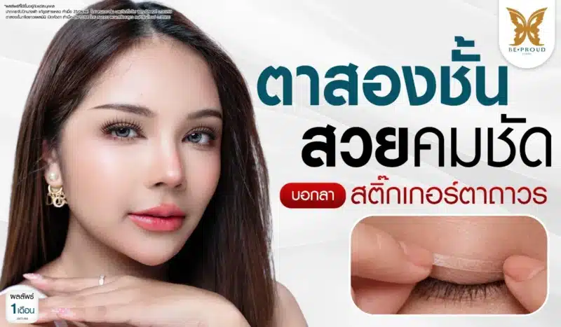 จบปัญหาตาชั้นหลบใน-ตาไม่เท่ากัน รีวิวศัลยกรรมตาสองชั้นสไตล์สายฝอ เคสคุณพิมพ์ ผลลัพธ์หลังทำ 1 เดือน ที่ บีพราวด์ คลินิก ( Beproud Clinic )